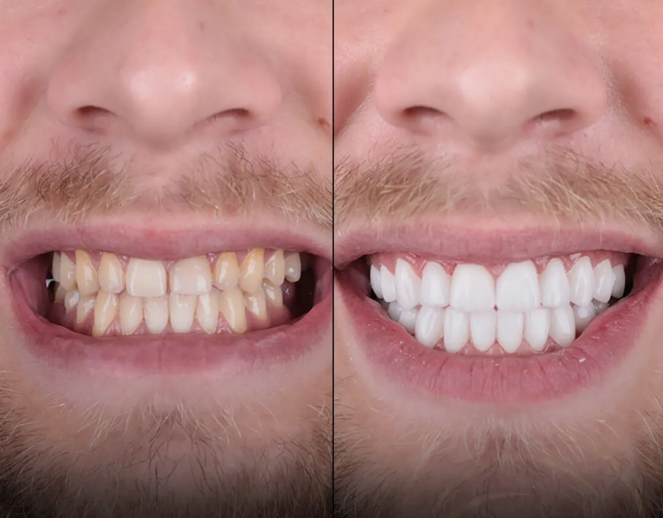 Dış Kapalama & İmplant