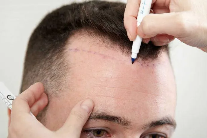 Saç Ekimi Yaptırmadan Önce Bilmeniz Gereken 5 Önemli Nokta